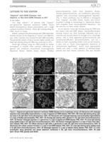 “Atypical” Anti-GBM Disease: Just Atypical, or Not Anti-GBM Disease at All?