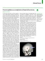 Pneumocephalus as a complication of basal cell carcinoma